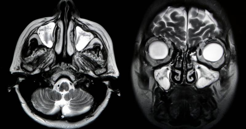 sinusitis röntgen felvétele