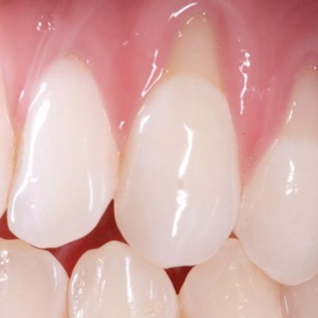 Dental enamel protective treatment