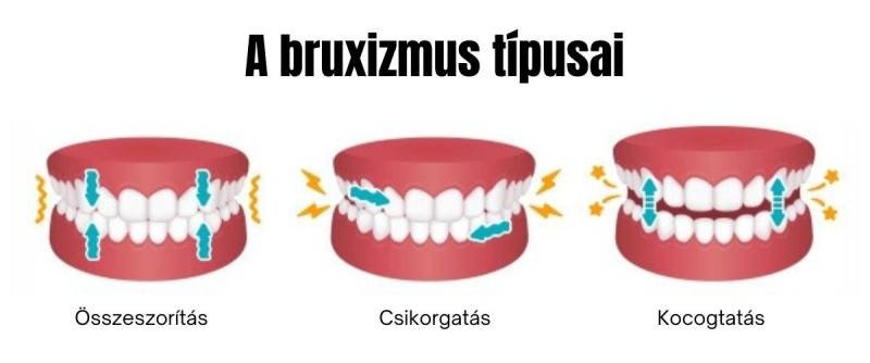 bruxizmus típusai